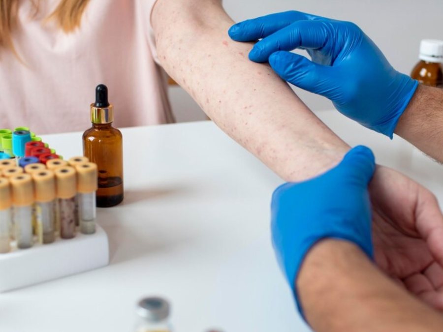 Prueba de Alergia Intradérmica