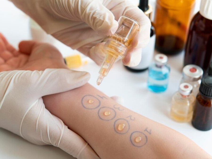 Prueba de Alergia Intraepidérmica
